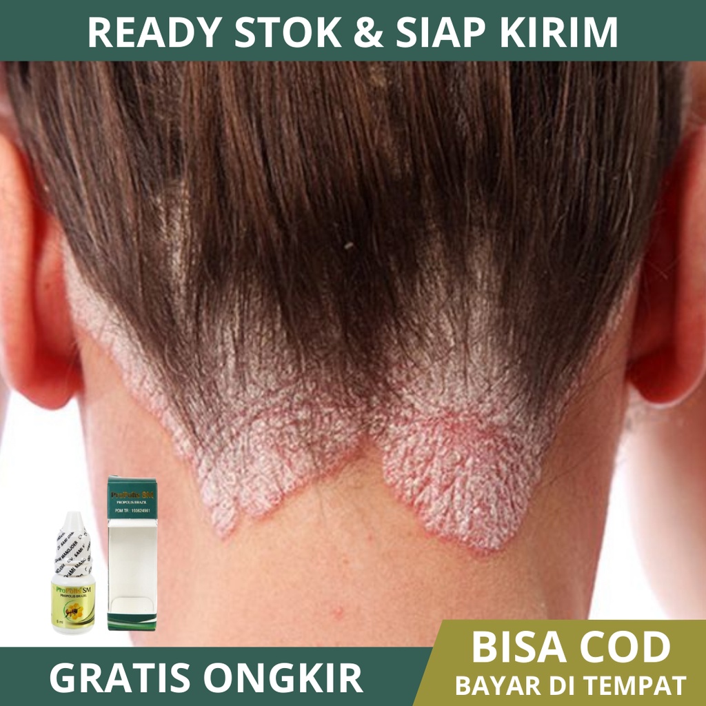 Obat Ketombe Kerak Kulit Kepala, Obat Ketombe Parah, Obat ketombe Berkerak, Obat Ketombe Kering di K