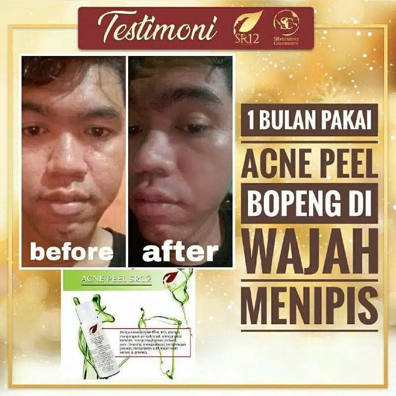 Penghilang Bopeng SR12 - Scar - Obat Bopeng - Penghilang Bekas Jerawat - Penghilang Jerawat