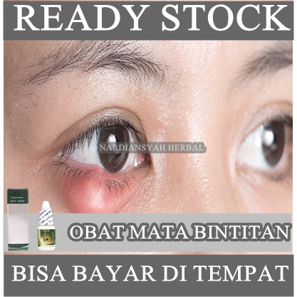 Jual Obat Oles Penghilang Benjolan Di Kelopak Mata, Salep Pengempis ...