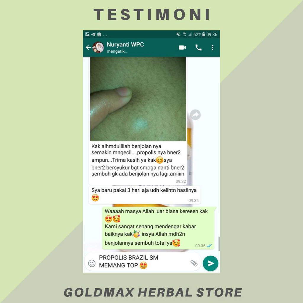 Obat Benjolan Payudara, Penghancur Benjolan di Payudara, Menghilangkan Lipoma, Benjolan Di Payudara, Benjolan Kelamin, Benjolan Ketiak, Benjolan Di Tangan/Kaki, Benjolan Kelamin, Kelenjar Getah Bening Dengan Propolis SM Brazil