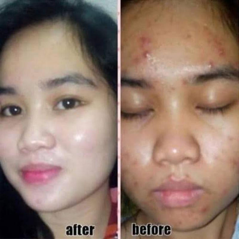 obat jerawat cream anti jerawat totol jerawat