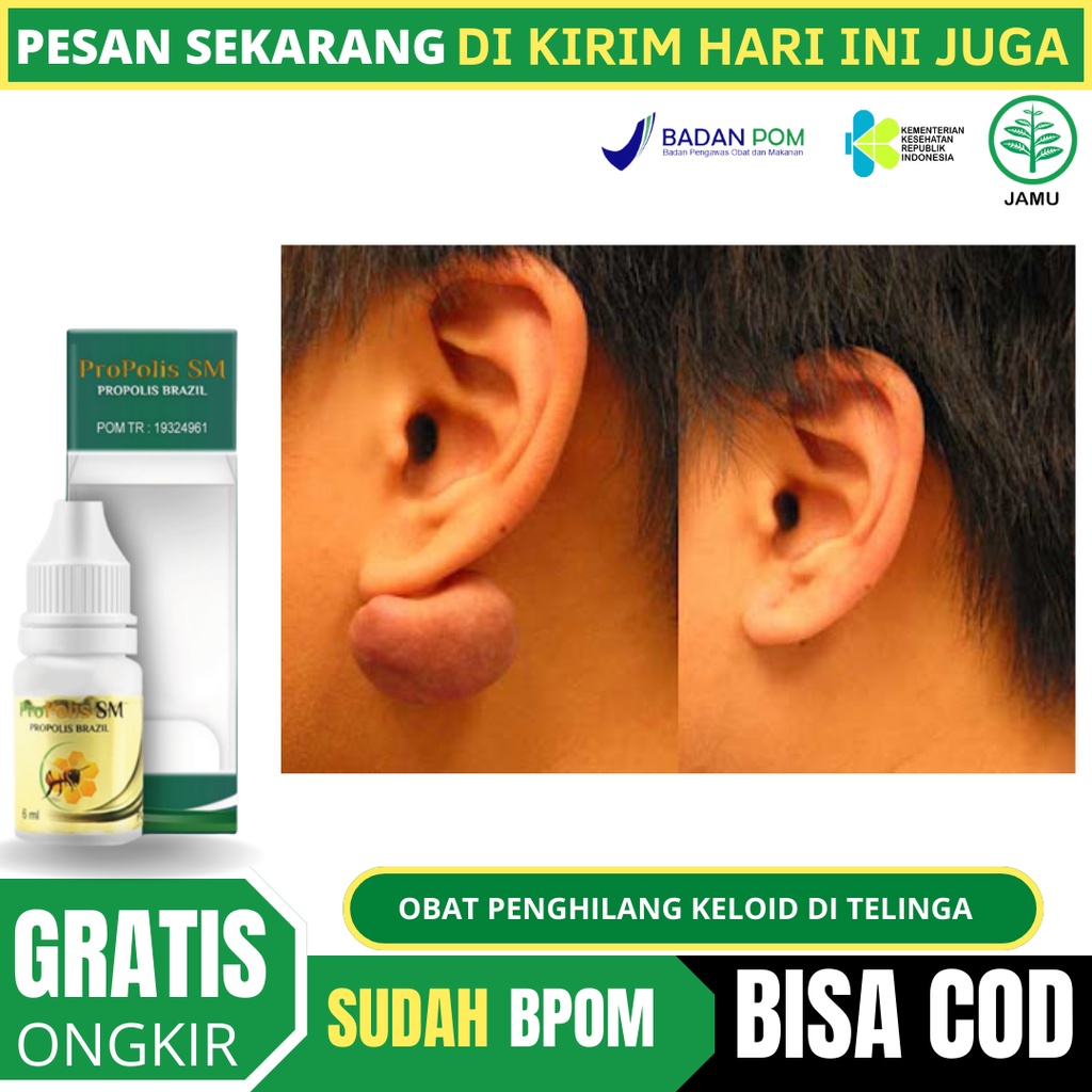 Jual Obat Keloid, Obat Keloid Di Telinga, Obat Penghilang Keloid di