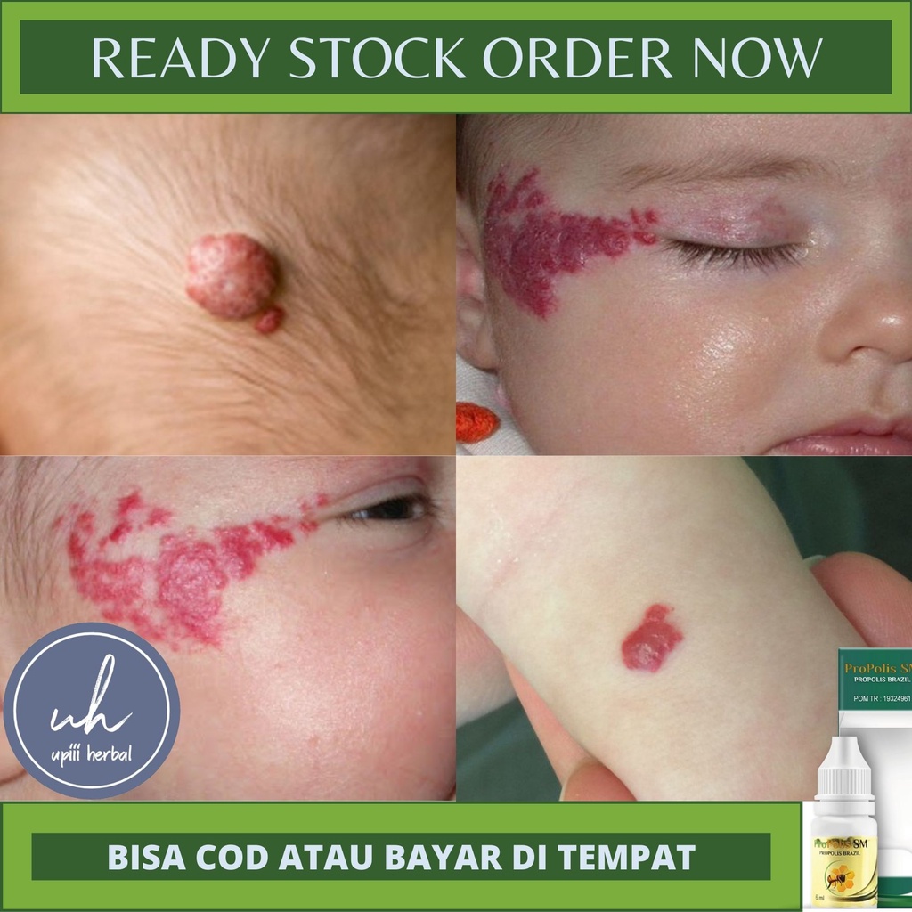 OBAT HEMANGIOMA - OBAT HERBAL ALAMI PENGHILANG HEMANGIOMA,HEMANGIOMA INFANTIL,KAVERNOSUM,KAPILER,PEC