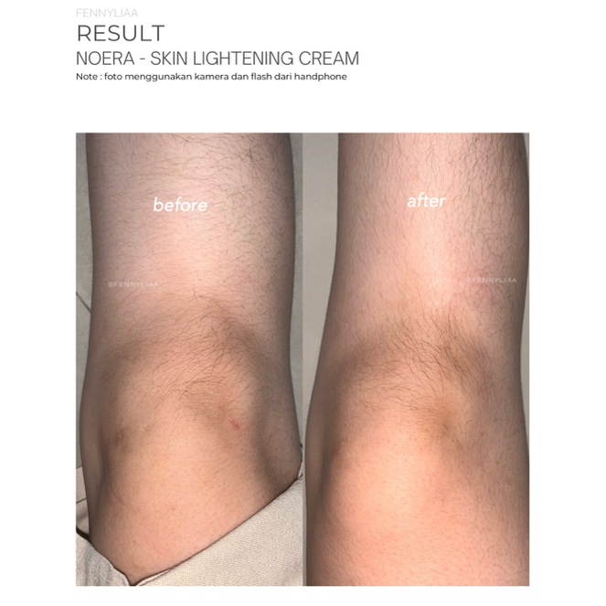 NOERA Skin Lightening Cream / Pencerah Lipatan Penghilang Bekas Luka