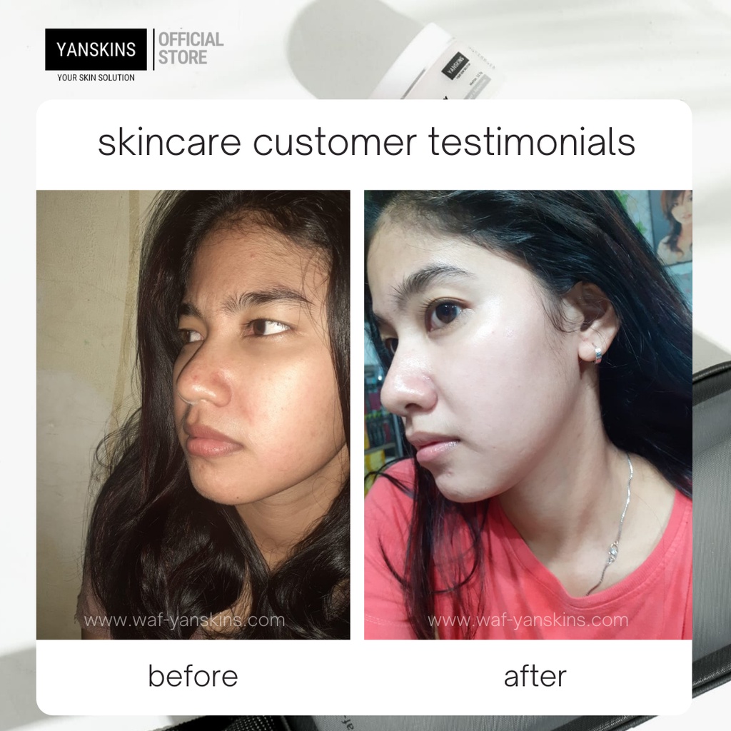 PAKET 6 ITEM SKINCARE BPOM BRIGHTENING SERIES SKIN CARE VARIAN PAKET ACNE FLEK DAN GLOW YANSKINS-7