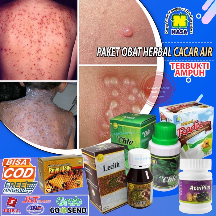 Obat Herbal Cacar Air Paket Obat Cacar Air Anak Dewasa Teruji Bpom Shopee Indonesia