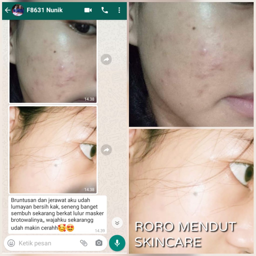 Masker Brotowali Penghilang Jerawat Bekas Jerawat Pencabut Komedo Roro Mendut Mini Acne Jerawat 20gr