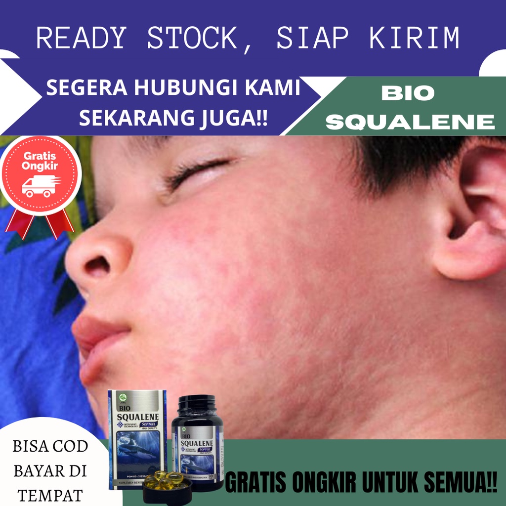 Obat Alergi Paling Banyak di Cari, Obat Alergi dan Gatal Anak, Kulit Gatal Bentol Anak atau Dewasa, 