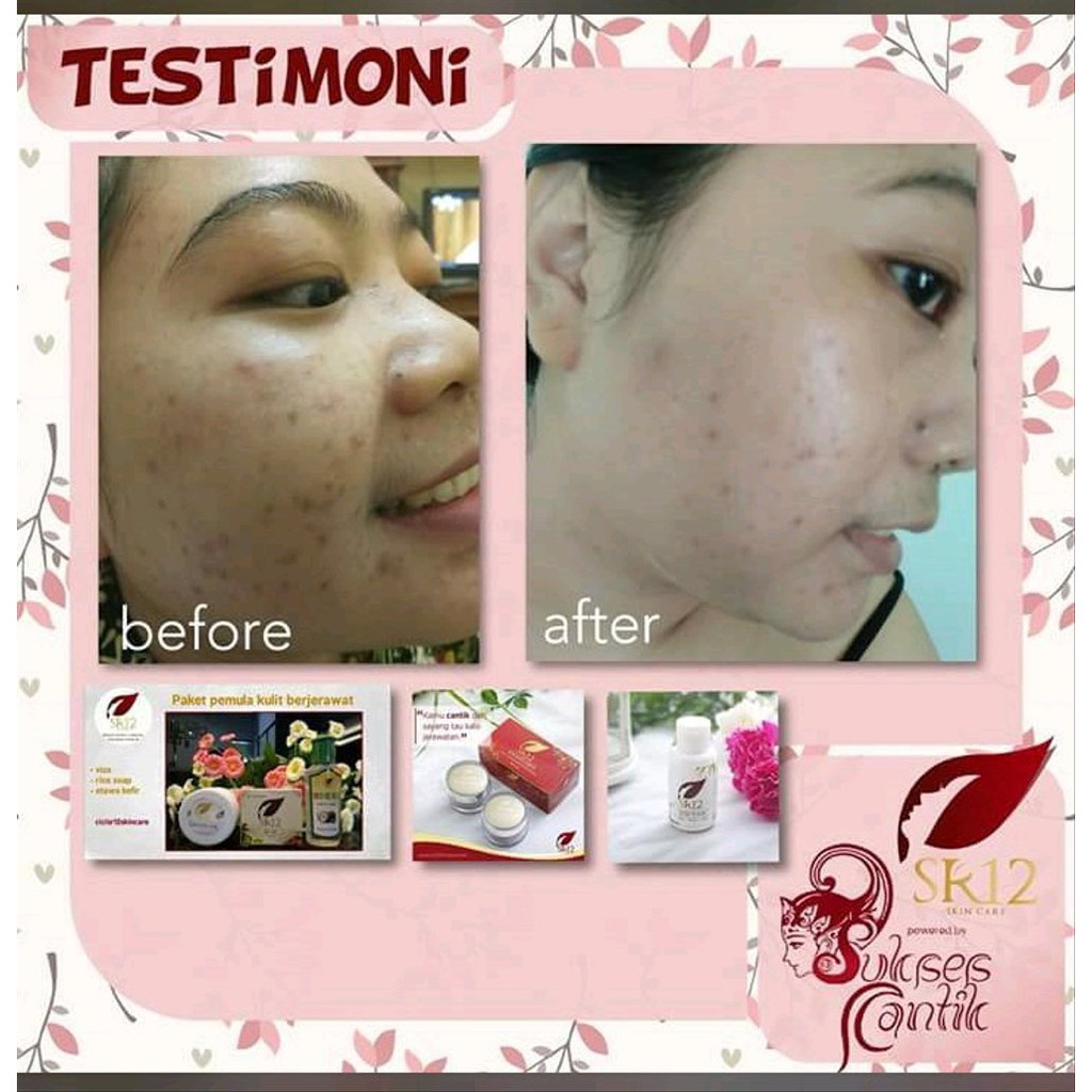 SR12 PAKET HEMAT ACNE / PAKET PENGHILANG JERAWAT