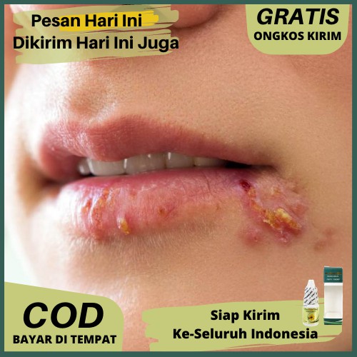 Obat herpes genital, herpes kulit, herpes kelamin, herpes mulut, herpes api Herbal Propolis SM Asli