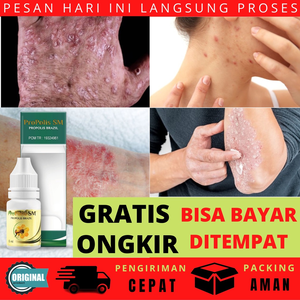 Obat Borok - Budug - Eksim - Iritasi Kulit - Kadas - Kudis - Kurap - Panu Alami Pustula Lenting Ruam