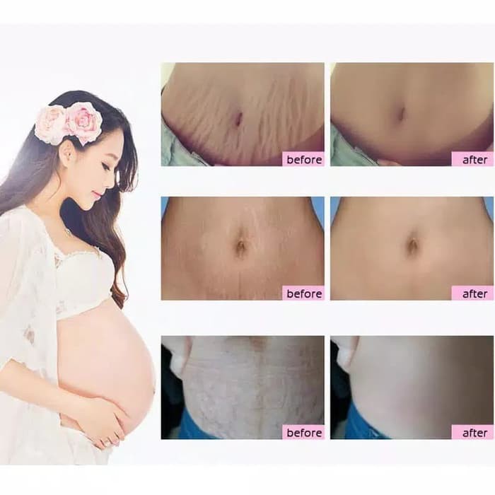 RtopR Krim Stretch Mark Ampuh Menghapus Bekas Kehamilan