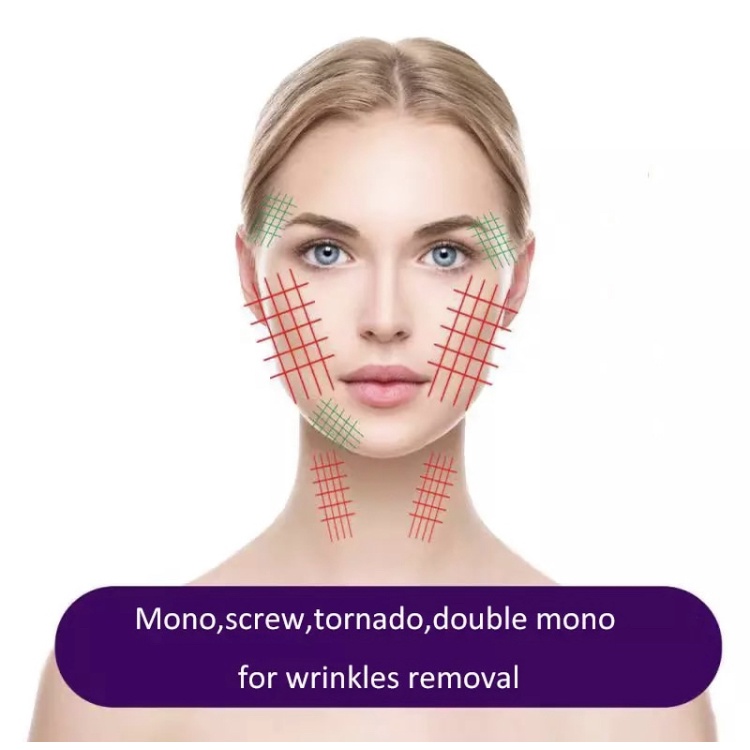 Tanam Benang PDO Screw Tanam Benang PCL Screw Mono Screw Thread Lift Benang Collagen Tanam Benang Wajah PDO Cog PCL Mono Tanam Benang Screw Tarik Benang Hapus Keriput