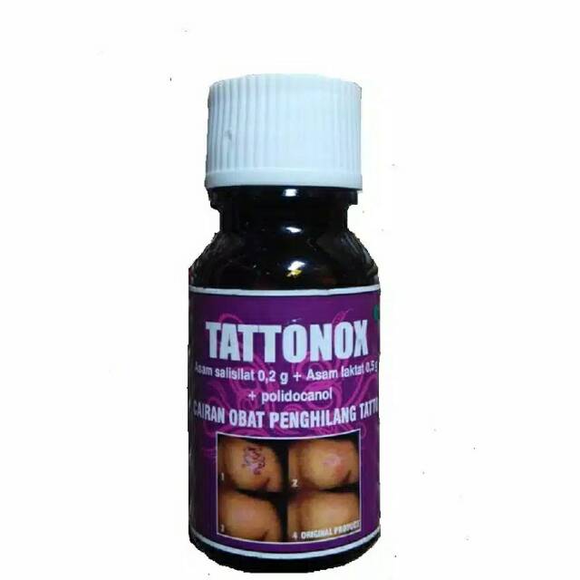 Tattonox removed