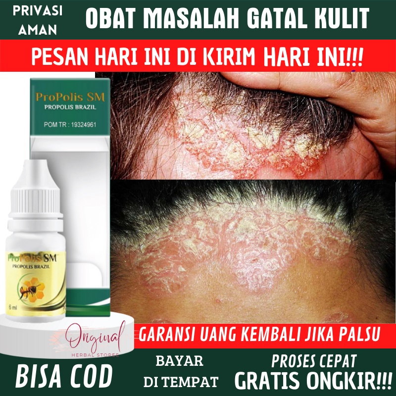 Obat tetes ketombe parah, Obat ketombe berkerak, Obat Psoriasis kulit kepala, Obat Jamur kepala, Oba
