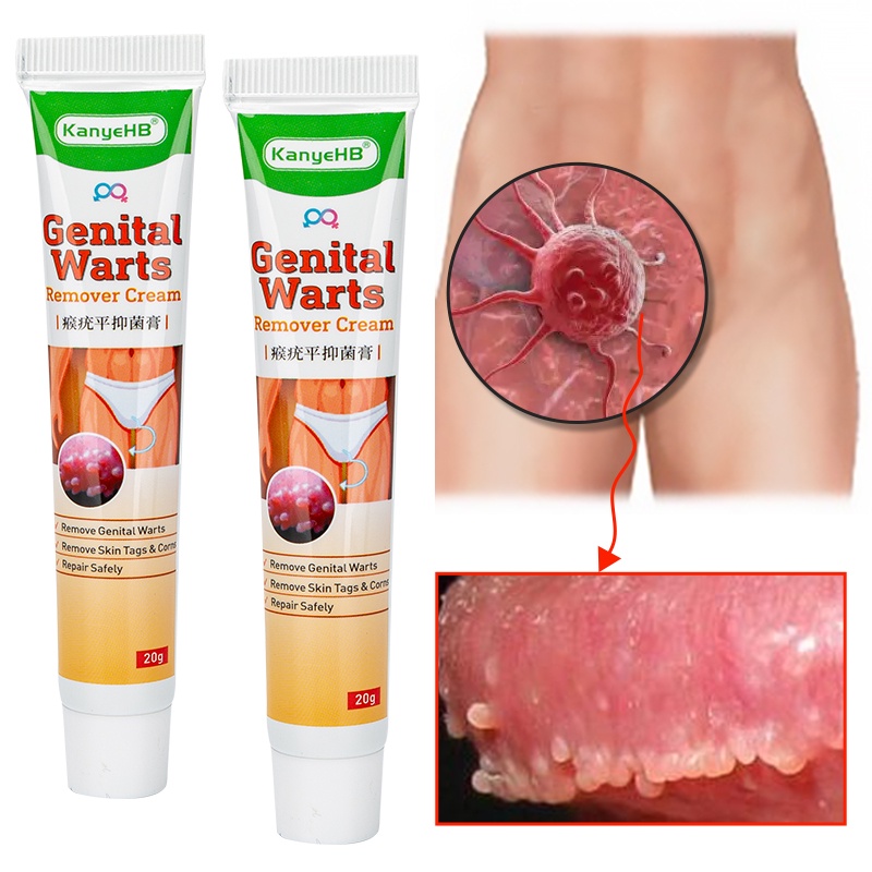 [Privasi Terjaga] KanyeHB Obat Kutil kelamin HPV Perontok Kutil Kelamin Pria / Wanita Salep Kutu Pubis Kelamin Penghilang Kutu Kelamin Genital Wart Remover -20gr