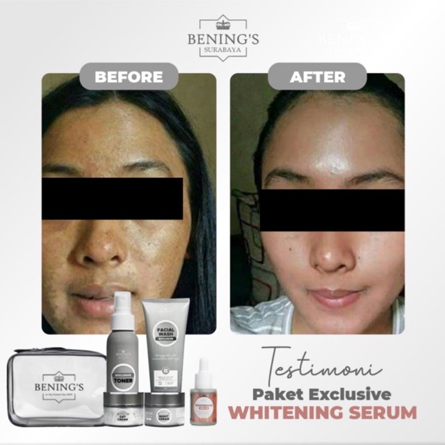 BENING'S PAKET EXCLUSIVE | MENGATASI FLEK, MELASMA &amp; MENCERAHKAN KULIT