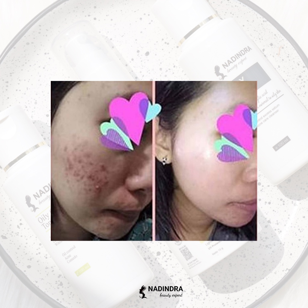 Nadindra Beauty Expert paket Pre Treatment Acne - step 1 / netralisir efek samping skincare keras-5