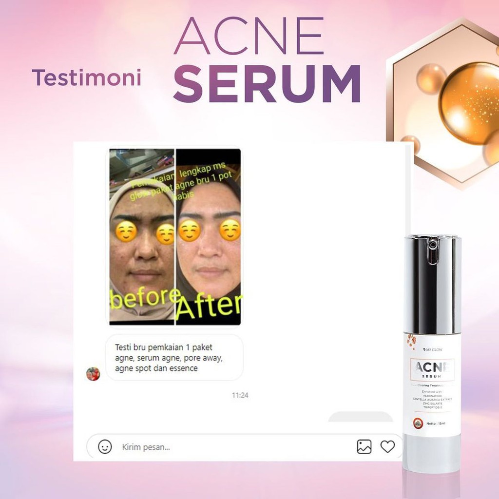 MS GLOW ACNE SERUM