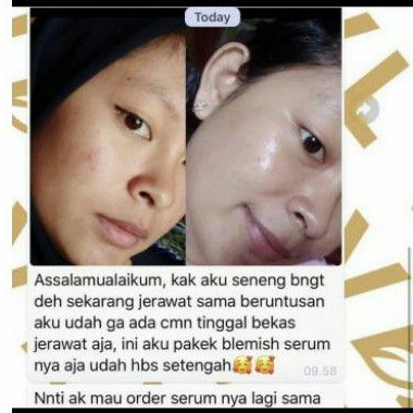 Paket Acne Package Vavl Beaute by Vivalentine free Pouch-6