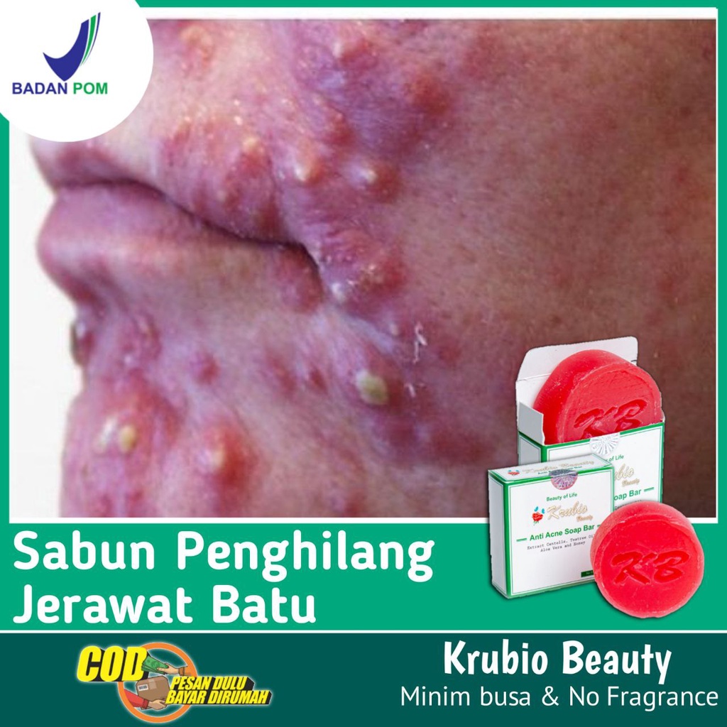 Sabun Wajah Penghilang Jerawat Batu Kistik Benjolan Besar Bernanah Bengkak Menahun dan Meradang - Sa