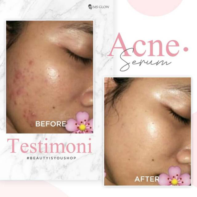 Ms Glow Serum Acne Original