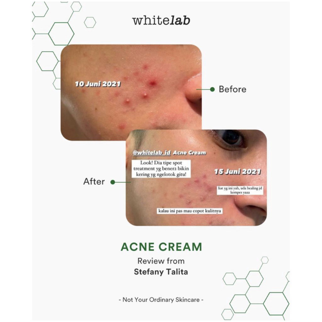 Whitelab Acne Cream 10ml