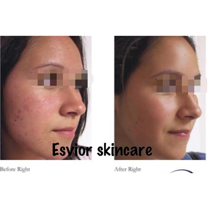 HAY065 [ DAY CREAM ] Esvior - ANTI ACNE GEL SERIES ( Day Cream ) BPOM