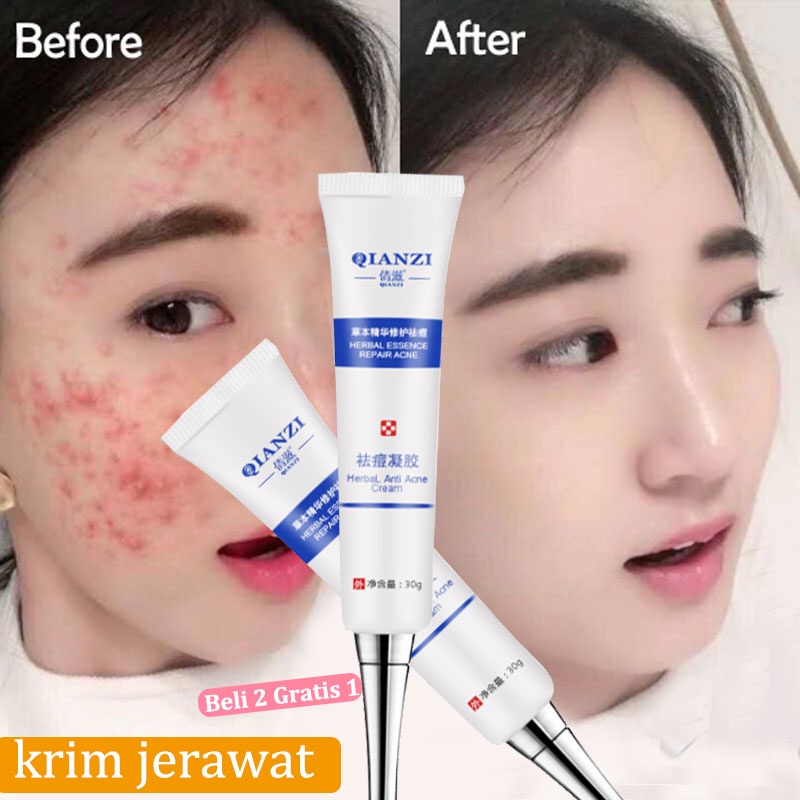 Cream Obat Jerawat Paling Ampuh ​Acne Rejuvenation Cream Jerawat Krim Jerawat Menghilangkan Jerawat Cepat Menghilangkan Jerawat Removal of Acne Cream Untuk Memperbaiki Kulit Denga Krim Penghilang Jerawat dan Bekas Jerawat Pria dan Wanita 30g