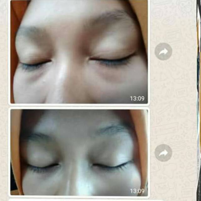 Eye lift gel