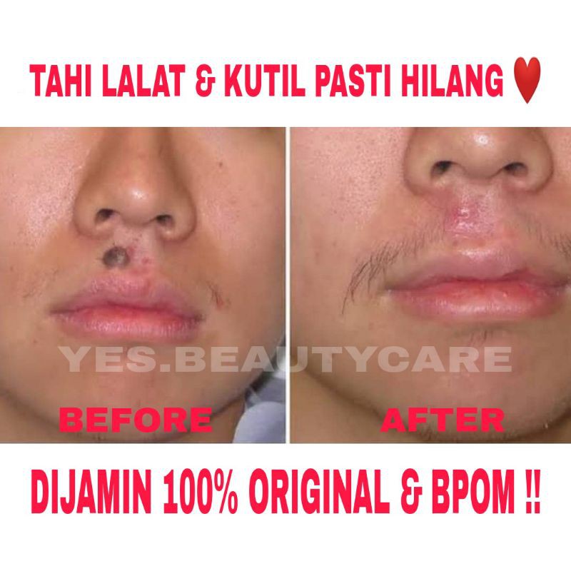 SWISS PARIS LOTION PENGHILANG TAHI LALAT &amp; KUTIL - SPESIALIS_TAILALAT - KRIM TAI LALAT OBAT ORIGINAL