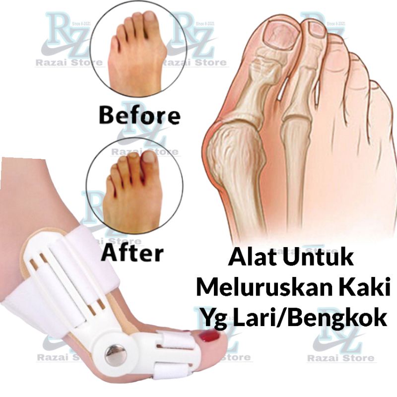 Pelurus Kaki Korektor Jempol Kaki Bunion Hallux Valgus Mmisen