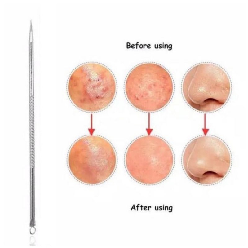 alat pencet komedo 2 in 1 pinset komedo facial blackhead removal