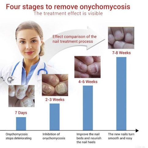 Obat Jamur Kuku Perawatan Kuku Kesehatan Kecantikan Kuku Kaki &amp; Tangan Obat Penghilang Jamur Kuku