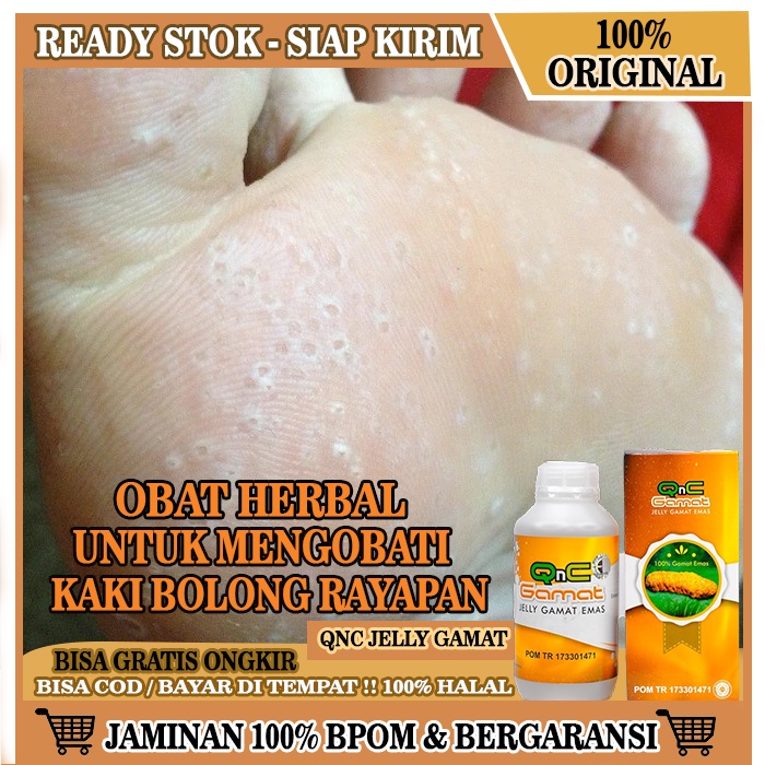 Obat Luka Kaki Bolong, Obat Kaki Rayapan, Telapak Kaki Bolong Berlubang, Obat Kaki Korodok, Obat Ray