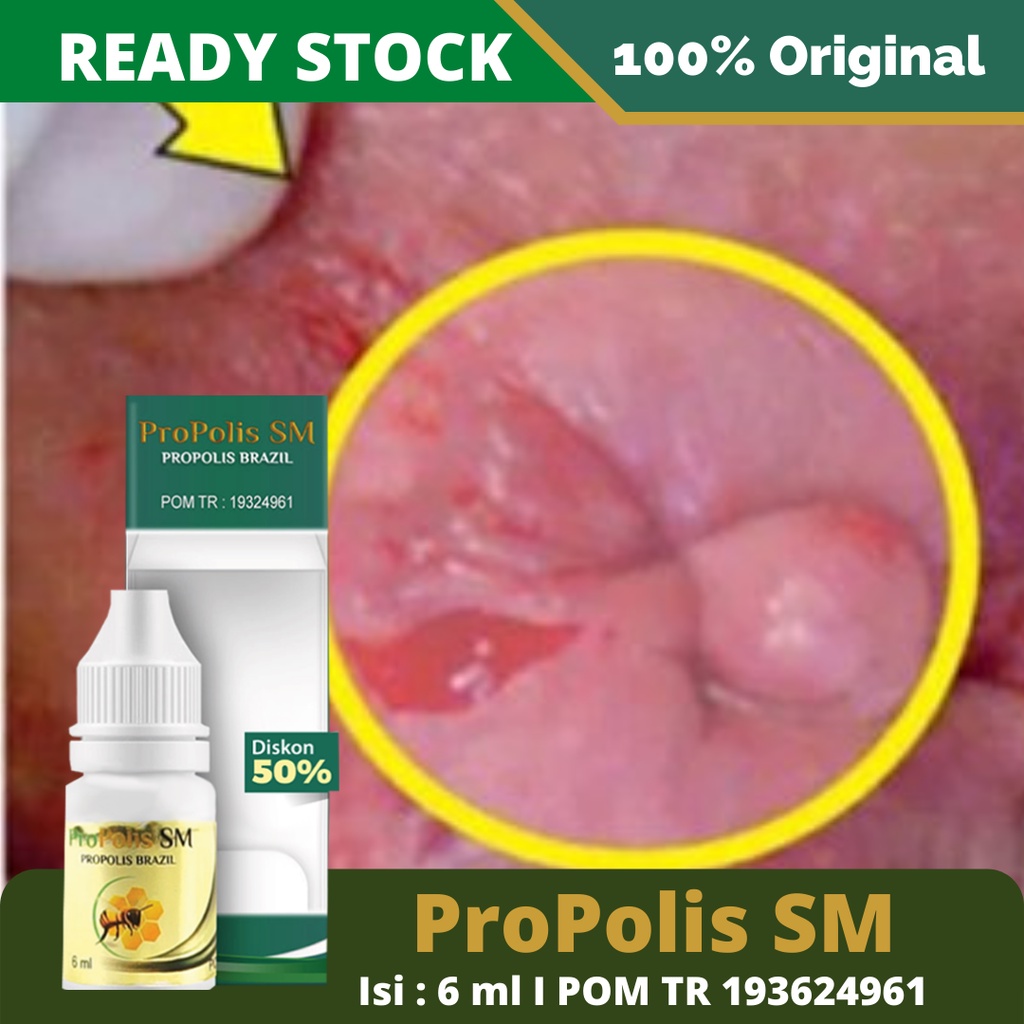 Obat Ambeien, Obat Herbal Ambeien, Obat Wasir Dan Ambein, Obat Stadium 3 4, Obat Ambein Menahun, Obat Anus Keluar, Nyeri Dubur, BAB Berdarah, Susah BAB, Benjolan Di anus, Obat Ambeien Wasir – ProPolis SM 100% Original BPOM