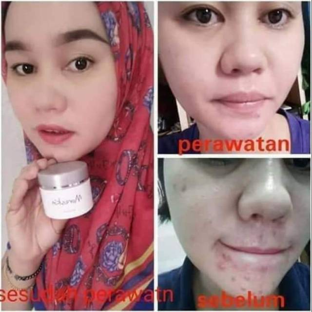 

Morenskin xacne