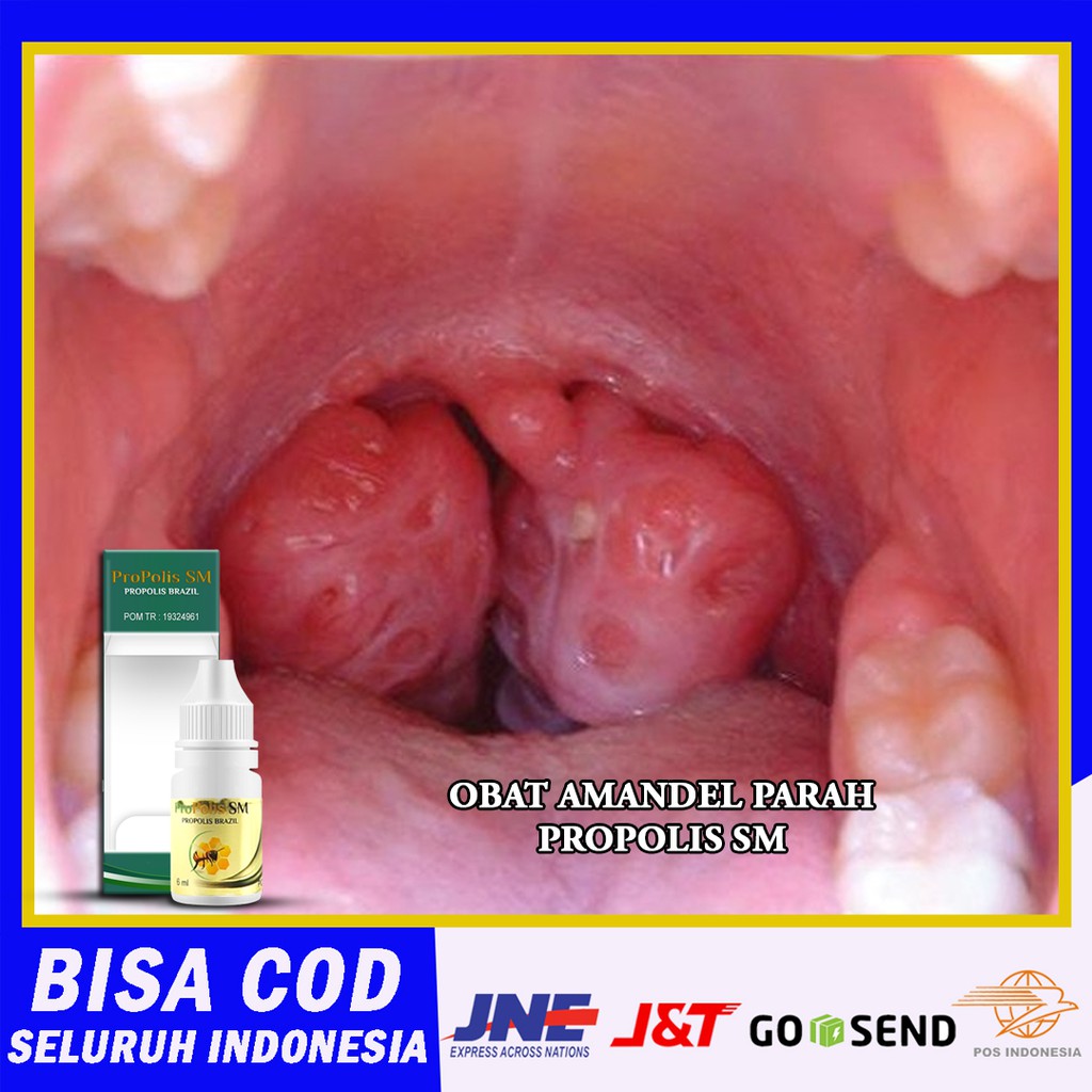 Obat Amandel Parah Anak & Dewasa, Tonsilitis, Amandel bengkak, Amandel Kronis - Propolis SM Brazil