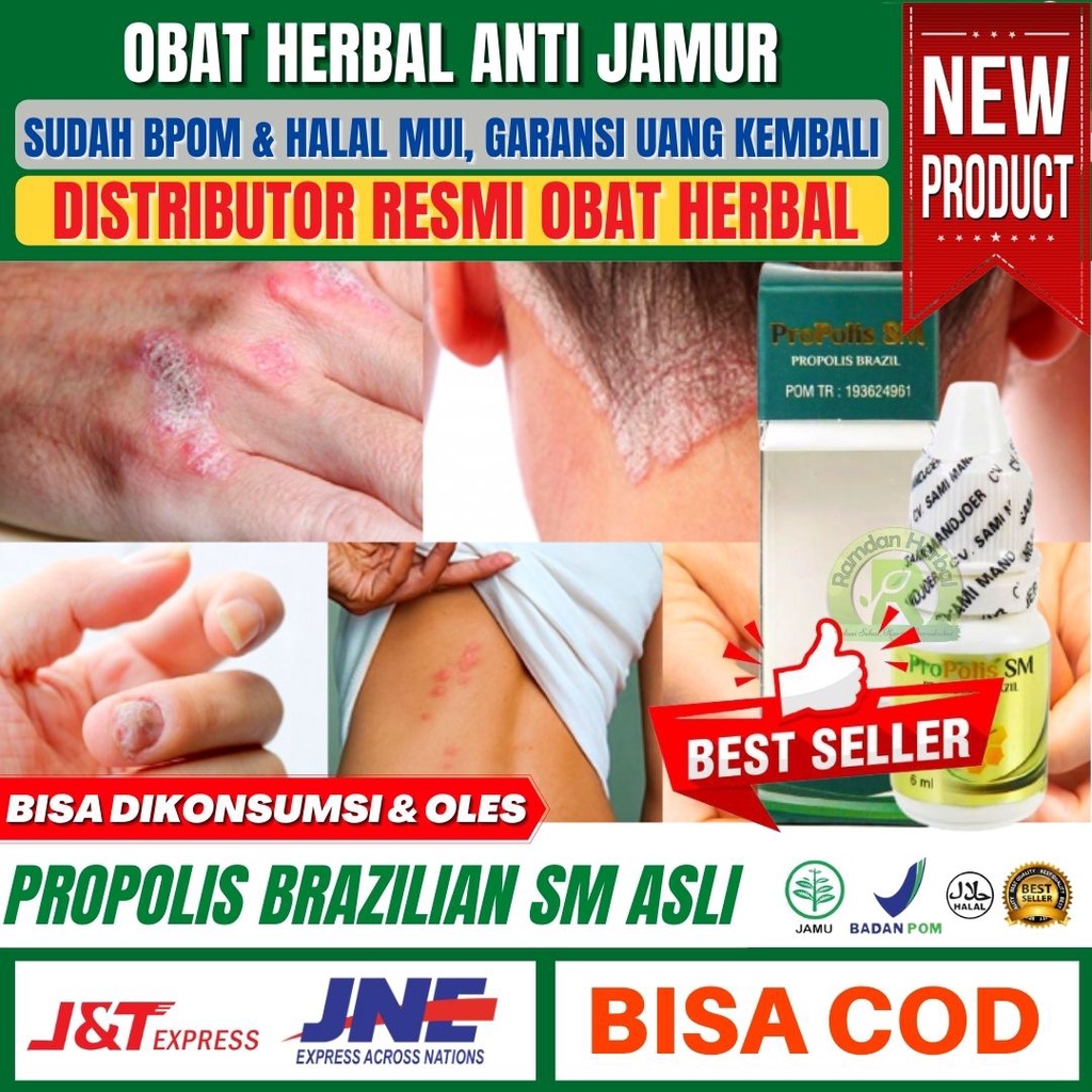 Obat ANTI JAMUR | Infeksi Jamur Di Kulit Kepala | Ketombe Berkerak | Borok Kulit Kepala | Eksim Kuli