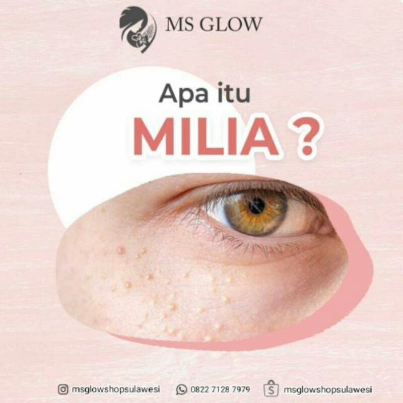 MS GLOW Paket Wajah Hempas Milia //Paket Menghilangkan Milia pada wajah ORIGINAL-1
