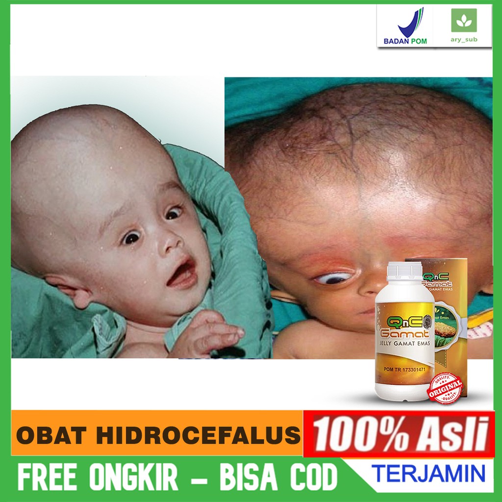 Obat Hidrocefalus / Hidrosefalus - Cairan Di Rongga Otak - Tumor Otak QnC Jelly Gamat Emas ASLI