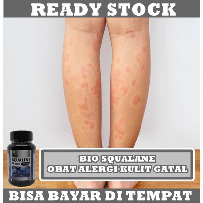 Obat Alergi Dingin Kulit Gatal Bentol, Alergi Makanan Laut, Alergi Kulit Gatal Di Tangan Murah, Alergi Gatal Gatal Untuk Anak dan Dewasa, Alergi Semen, Alergi Gatal Kulit Bio Squalene Original 100% Original Halal Herbal BPOM