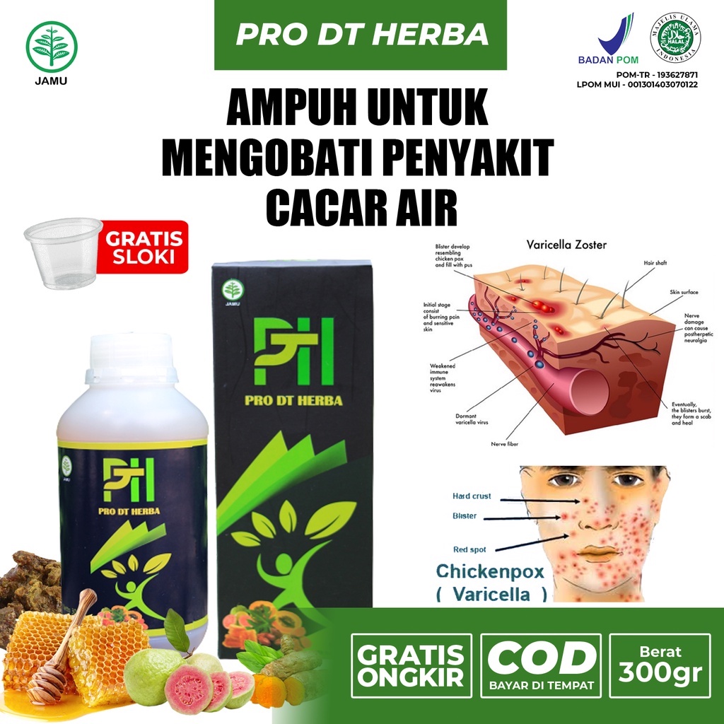 Obat Cacar, Obat Herbal Mengatasi Cacar Air Anak Dewasa Paling Ampuh, Obat Gatal Kulit Terbaik PRO D