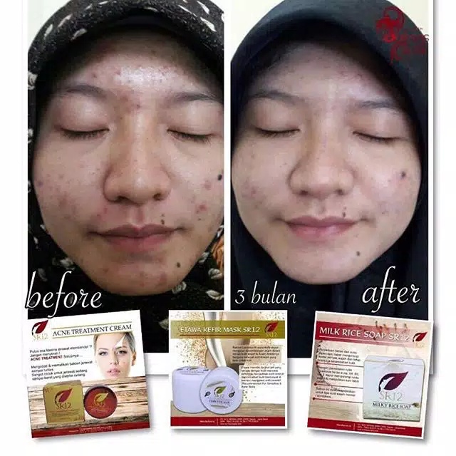 MASKER KEFIR SUSU BPOM//SR12 MILK KEFIR ORIGINAL//TERAMPUH UNTUK KULIT KUSAM &amp; KERING