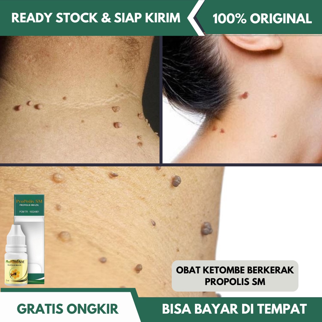 Obat Kutil di Leher, Obat Kutil Tangan, Obat Papiloma, Obat Penghilang Papiloma di Leher - Propolis 