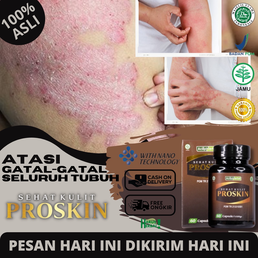 Obat Gatal Di Seluruh Tubuh, Obat Penyakit Gatal Kulit Menahun, Obat Gatal Alergi, Gatal Eksim Kerin