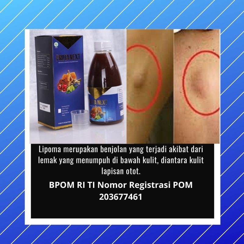 FRUTANEXT  Menghilangkan Lipoma Dengan Madu | Cara Mengobati Lipoma FRUA NEXT | FRUTANEXT