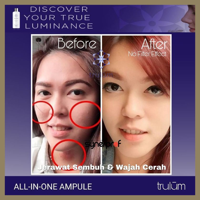 

Sangat Ampuh Atasi Jerawat - Trulum Pengganti Cream Krim Siang Malam