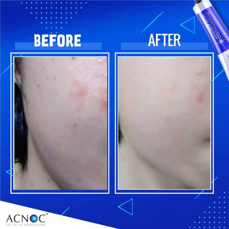 Acnoc Anti Acne Gel