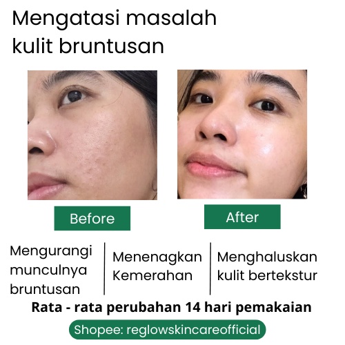 REGLOW ACNE Skincare dr Shindy Putri Perawatan Wajah Untuk Kulit Berminyak Kusam Sensitif Krim Penghilang Bekas Jerawat Merah Flek Hitam Membandel Komedo Milia 1 Paket Lengkap Murah Official Store Ori